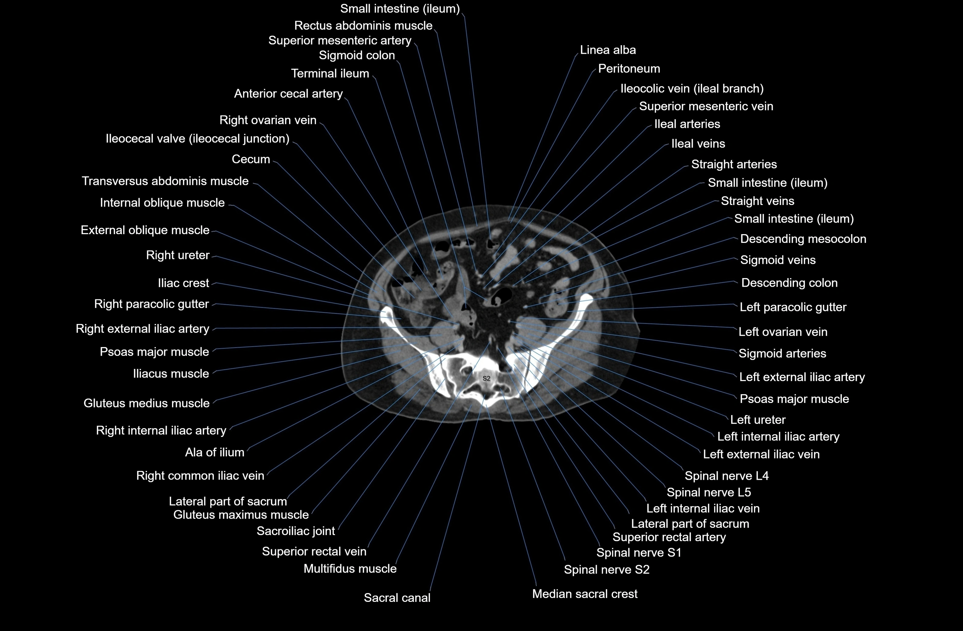 CT Abdomen axial cross sectional anatomy labelled radiology image-00069.webp